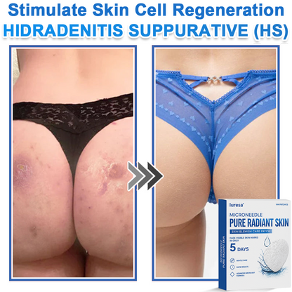 🍁luresa® 2-in-1 Microneedle & Hydrocolloid Patch | Raised Moles,Acne,  Flat Warts & Skin Tags Remover | Improves Wrinkles, Scars & Blemishes | Invisible Pimple Patches for Face & Body