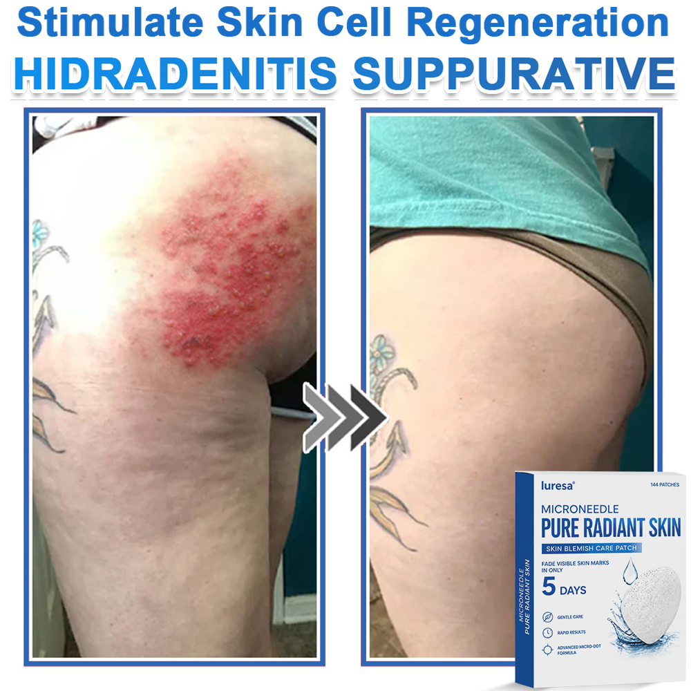 🍁luresa® 2-in-1 Microneedle & Hydrocolloid Patch | Raised Moles,Acne,  Flat Warts & Skin Tags Remover | Improves Wrinkles, Scars & Blemishes | Invisible Pimple Patches for Face & Body