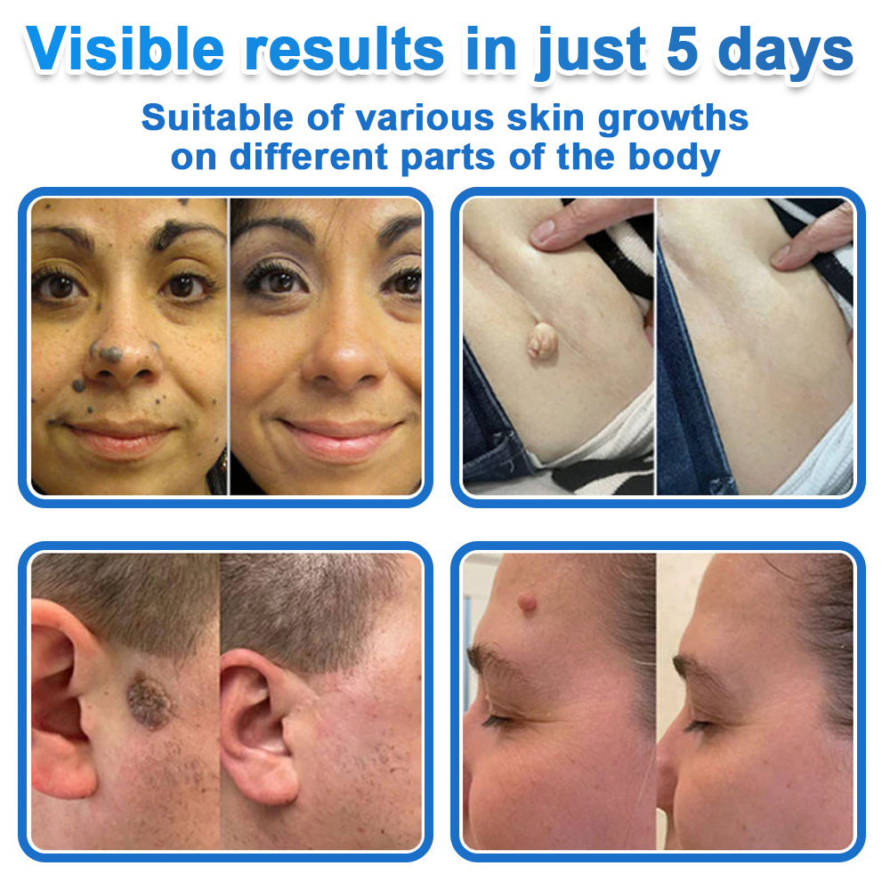 🍁luresa® 2-in-1 Microneedle & Hydrocolloid Patch | Raised Moles,Acne,  Flat Warts & Skin Tags Remover | Improves Wrinkles, Scars & Blemishes | Invisible Pimple Patches for Face & Body
