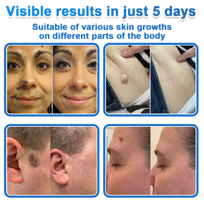 🍁luresa® 2-in-1 Microneedle & Hydrocolloid Patch | Raised Moles,Acne,  Flat Warts & Skin Tags Remover | Improves Wrinkles, Scars & Blemishes | Invisible Pimple Patches for Face & Body