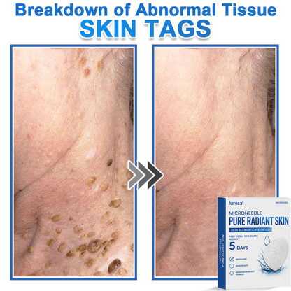 🍁luresa® 2-in-1 Microneedle & Hydrocolloid Patch | Raised Moles,Acne,  Flat Warts & Skin Tags Remover | Improves Wrinkles, Scars & Blemishes | Invisible Pimple Patches for Face & Body
