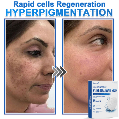 🍁luresa® 2-in-1 Microneedle & Hydrocolloid Patch | Raised Moles,Acne,  Flat Warts & Skin Tags Remover | Improves Wrinkles, Scars & Blemishes | Invisible Pimple Patches for Face & Body